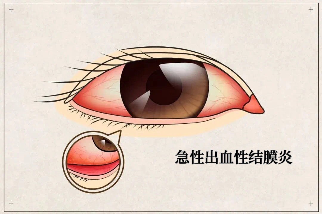 广东疾控重要提醒：红眼病高发！多人已中招！预防看这里